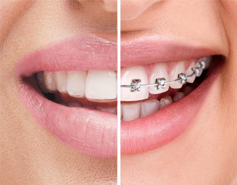  Clear Aligners Vs Metal Braces: Do Clear Aligners Work Better Than Braces?