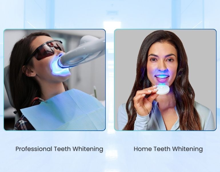 A Comparison of Professional and at-home Teeth Whitening Methods