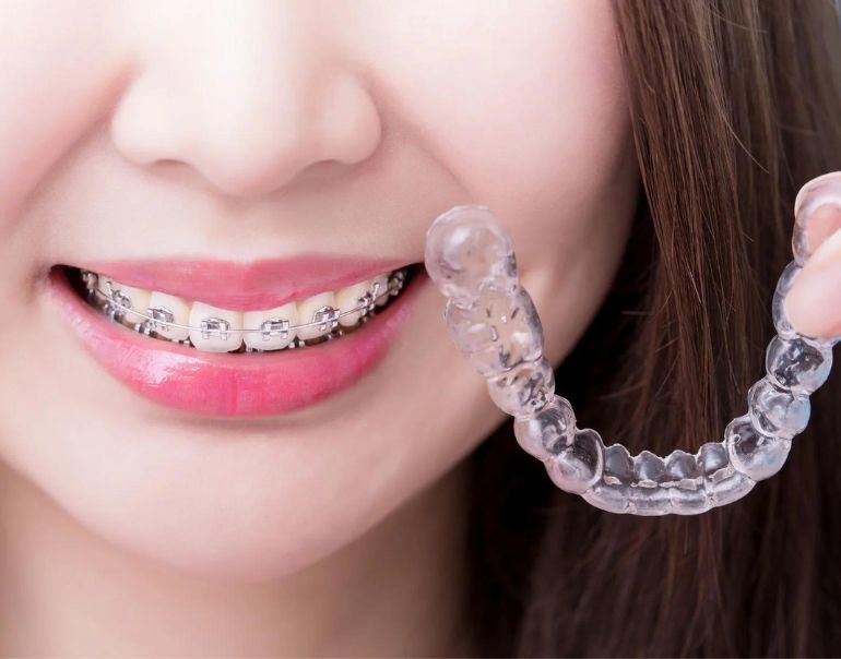 invisible-braces-vs-traditional-braces-which-is-right-for-you