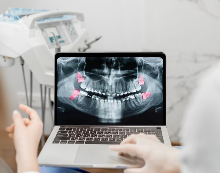 Is Removal of All 4 Wisdom Teeth Necessary